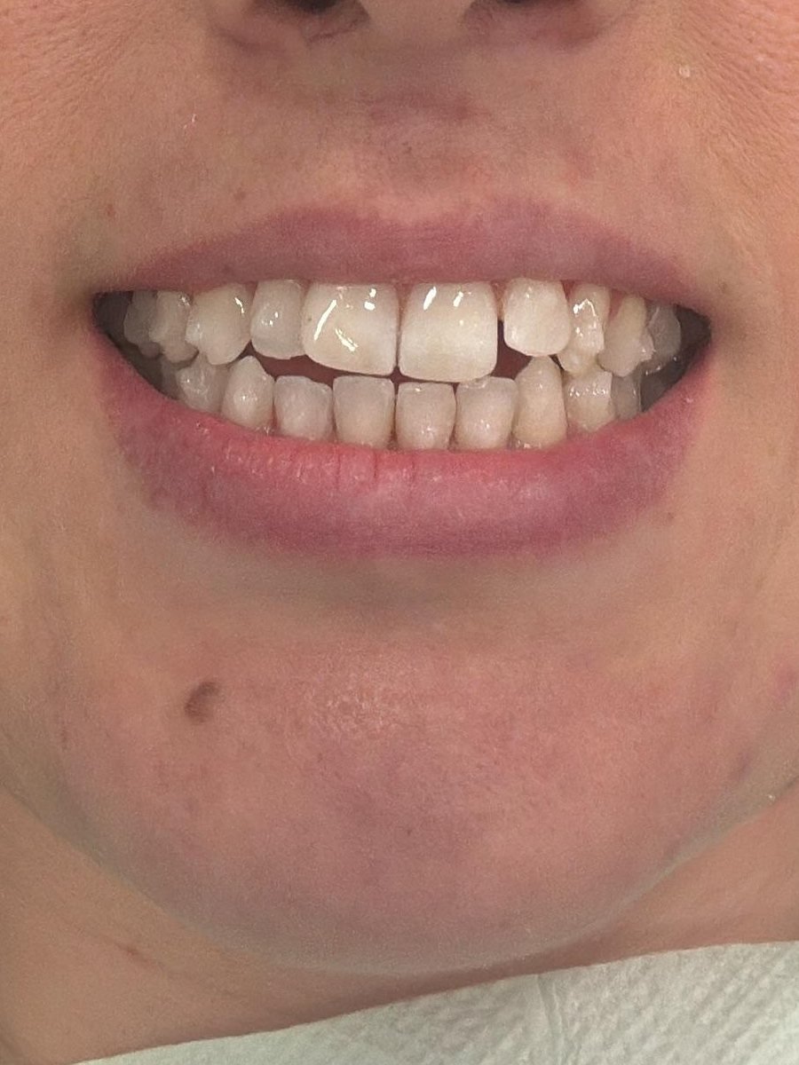 Sorriso da paciente antes do tratamento com Invisalign